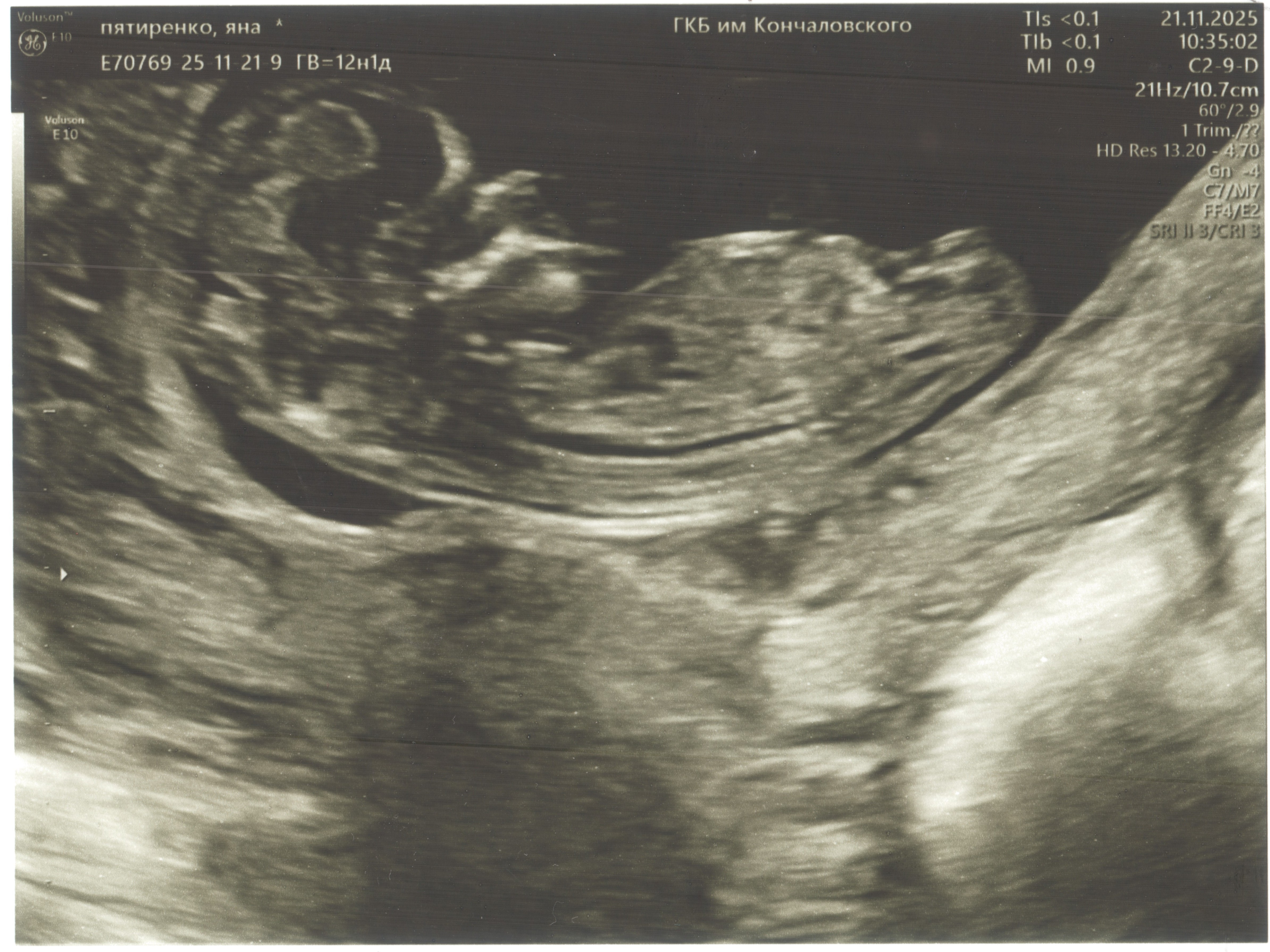 Скрининг №1 (12 недель)