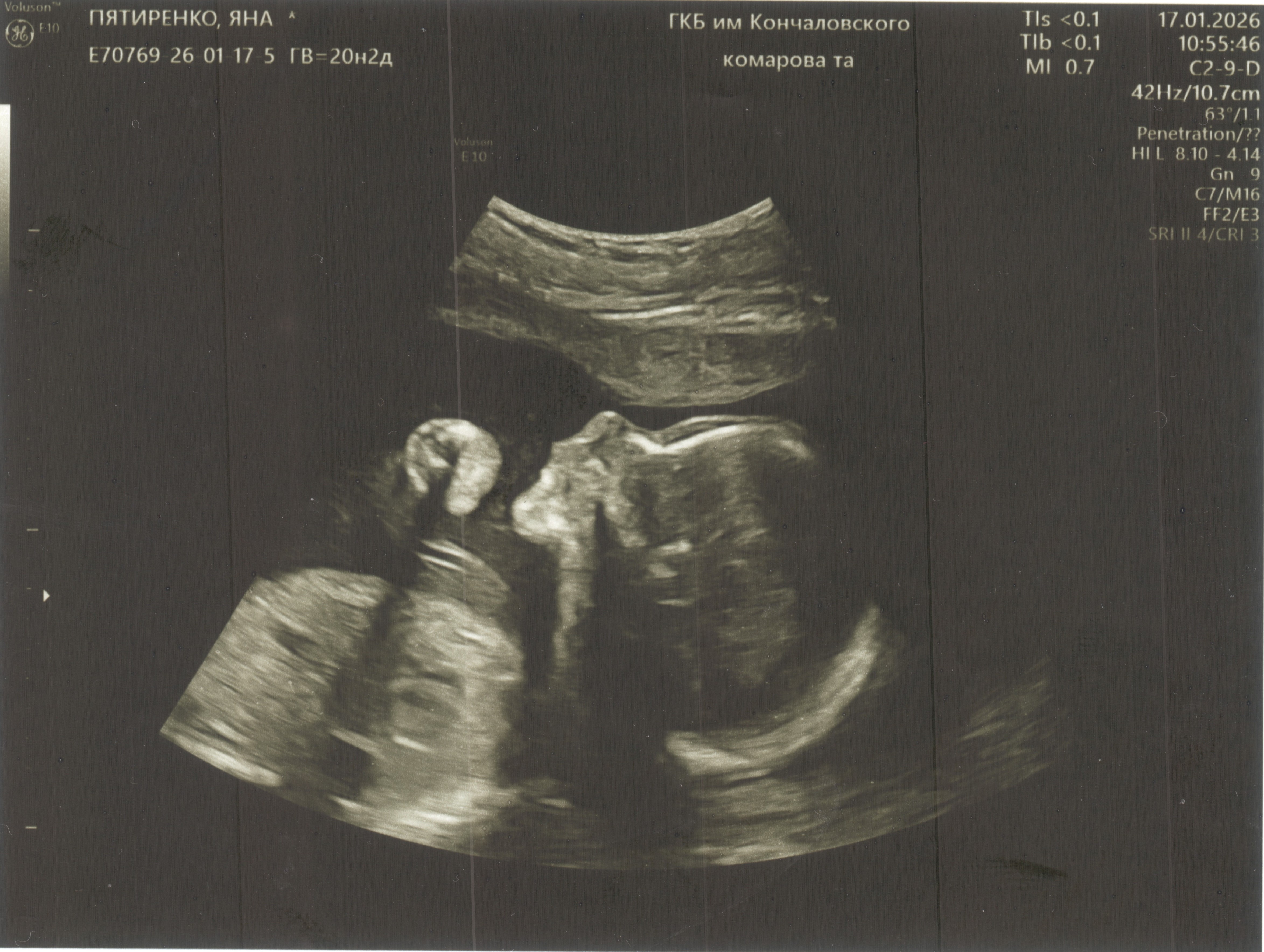 Скрининг №2 (20 недель)